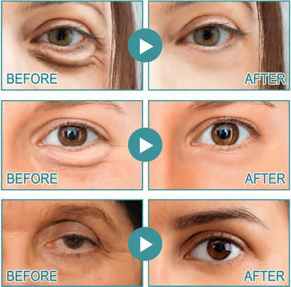 Epidova | Dissolving Microneedle Eye Patches
